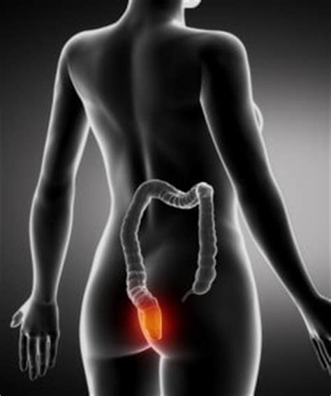 Cáncer de colon y recto   Qué es? síntomas, tratamiento ...