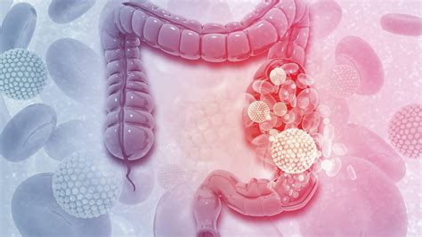 Cáncer de colon y recto: síntomas y tratamiento