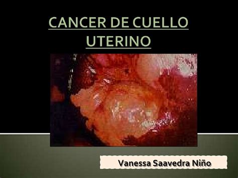 CANCER DE CUELLO UTERINO  CERVIX