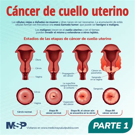 Cáncer de cuello uterino   Infografía