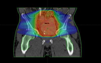 Cáncer de Cuello Uterino: Perspectivas clínicas de la ...