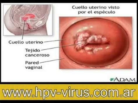 Cancer de cuello uterino por HPV   YouTube