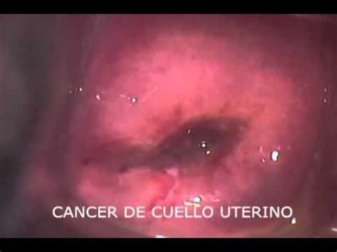 Cancer De Cuello Uterino   YouTube