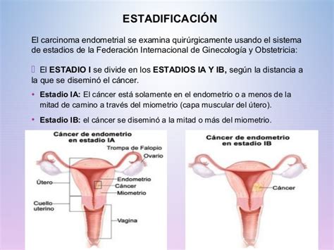 Cancer de endometrio