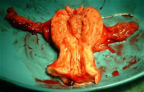 Cancer De Endometrio Sintomas Iniciales   SEONegativo.com
