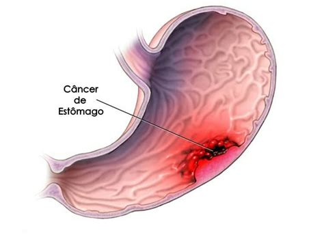 Cancer De Esofago   SEONegativo.com