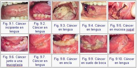 Cancer De Esofago Sintomas Iniciales   SEONegativo.com