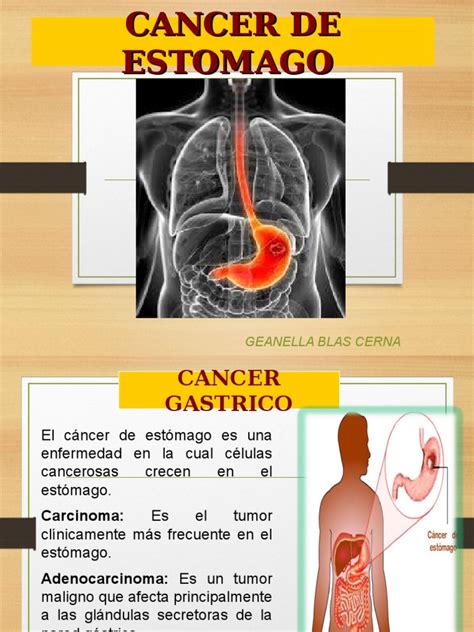 Cancer de Estomago | Cáncer | Estómago