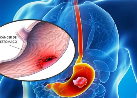 Cáncer de estómago: causas, síntomas, tratamientos y más