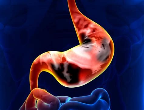 Cáncer de estómago ¿cómo reconocerlo? síntomas y pruebas