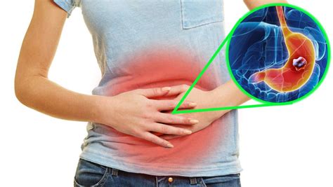 Cáncer de estómago: ¿Qué es?   El Carabobeño