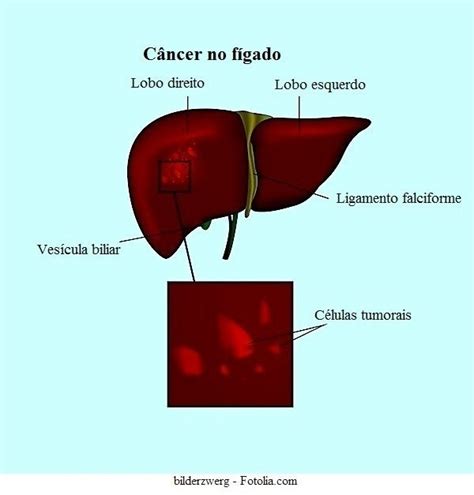 Câncer de fígado, sintomas e causas, metastático, tumor benigno