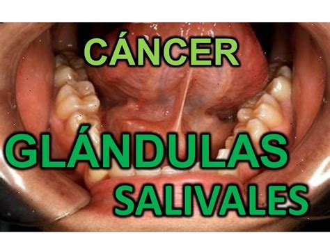 Cancer De Glandulas Salivales Sintomas