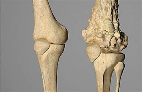 Cáncer de Huesos: Causas, Síntomas y Tratamiento 】