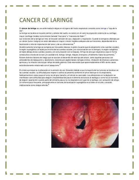Cancer de laringe