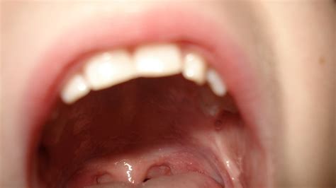 Cáncer de lengua: Causas, primeros síntomas y tratamiento