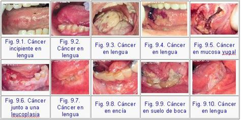 Cancer De Lengua Sintomas Fotos