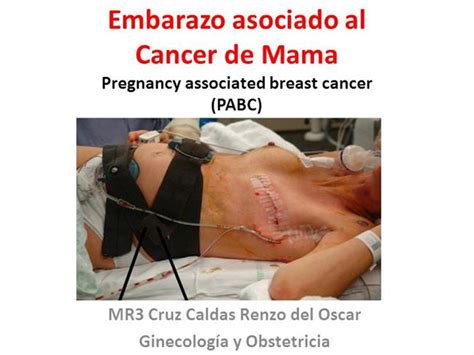Cancer de Mama Asociado a Embarazo   2014 USP |authorSTREAM