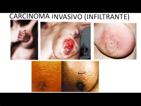 Cancer de mama Carcinoma ductal Infiltrante YouTube