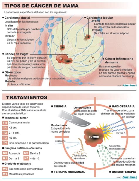 Cáncer de mama: cuestión de cogerlo a tiempo como clave ...