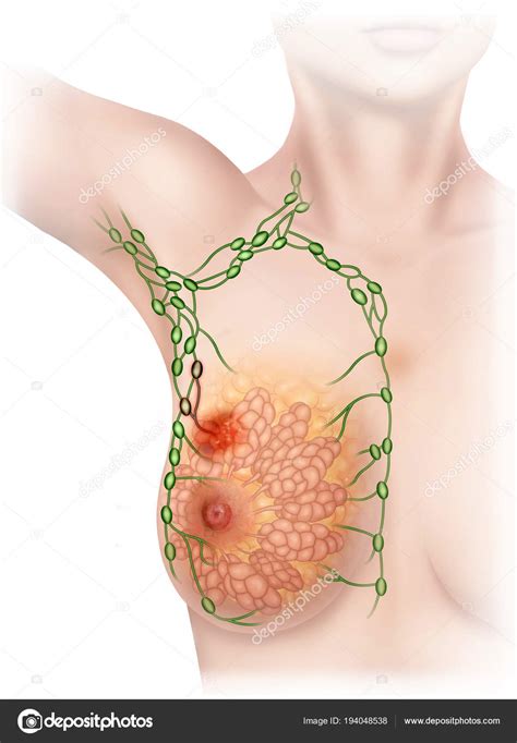 Cáncer de mama detectado en el sistema linfático — Foto de ...