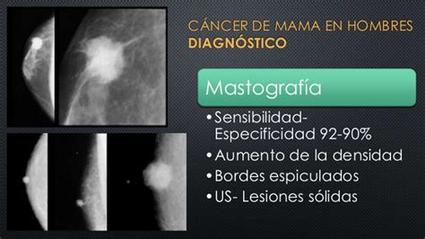Cancer de mama en hombres  revisión