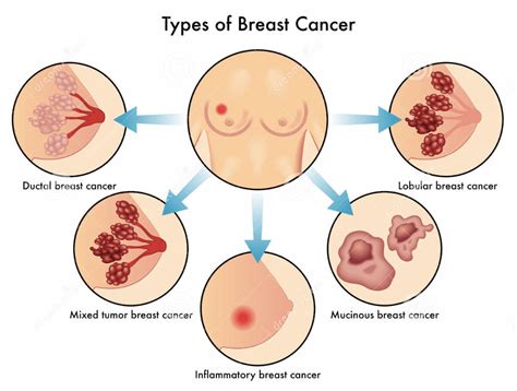 CANCER DE MAMA : ¿Qué tan común es el cáncer de seno?