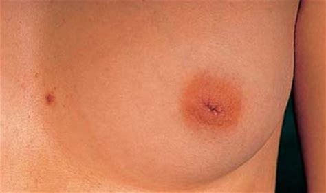 Cáncer de mama: tumor maligno que se forma en el tejido de ...