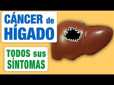 Cancer De Ovario Con Metastasis   Endoscopia de Metastasis ...