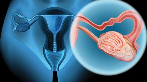 Cáncer de ovario: conoce sus síntomas – Telemundo New York  47