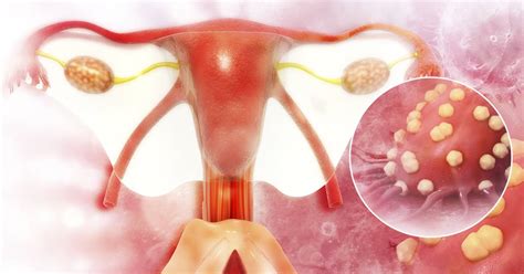 Cáncer de ovario: ¿en qué consiste?, ¿cuáles son sus síntomas?