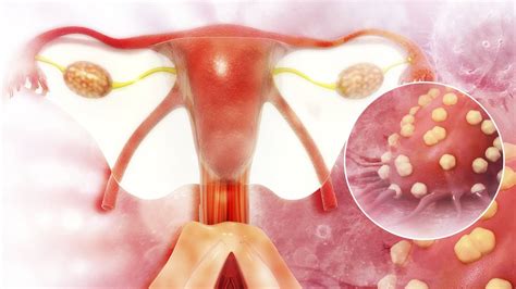 Cáncer de ovario: ¿en qué consiste?, ¿cuáles son sus síntomas?