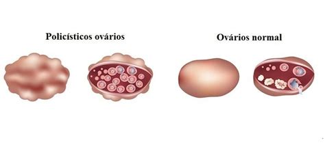 Câncer de ovário, estágios, sintomas e tratamento