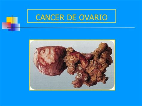 Cancer De Ovario