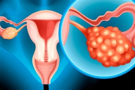 Cáncer de ovario  ovárico : qué es, síntomas y tratamiento   Tua Saúde