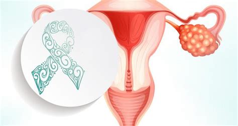 Cáncer de ovario: ¿Qué es y cómo podemos prevenirlo?