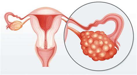 Cáncer de ovario | Telediario Digital
