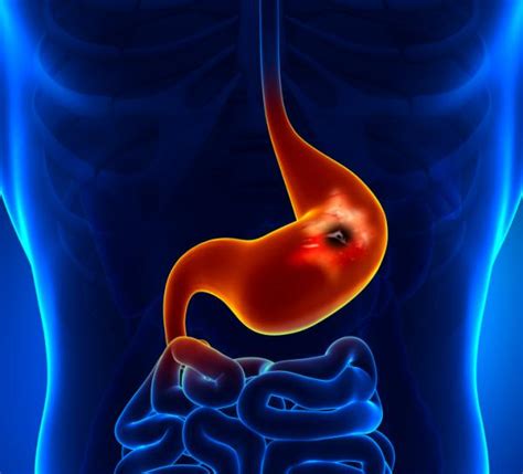 Cáncer de páncreas: causas, síntomas y tratamiento