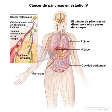 Cáncer de páncreas  PDQ —Versión para pacientes ...