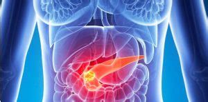 cancer de pancreas tratamiento   IOCir