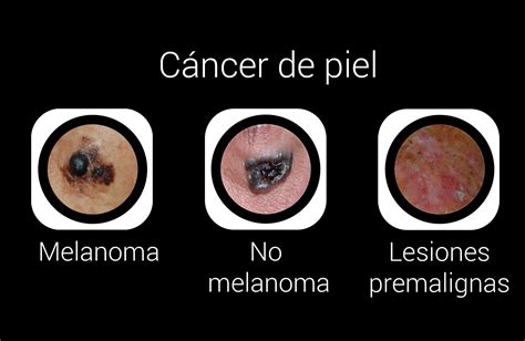 Cáncer de piel. Melanoma y no melanoma. Detección precoz