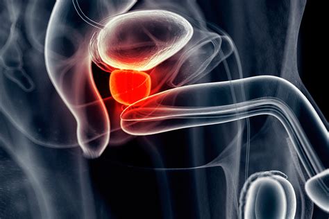 Câncer de próstata: as novidades que levam à cura da doença | VEJA