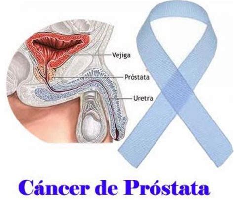 Cancer De Prostata Avanzado Esperanza De Vida   CancerWalls