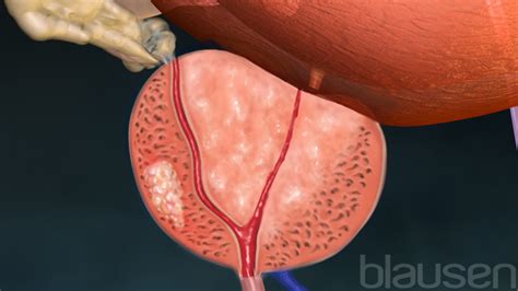 Cáncer de Próstata | Blausen Medical
