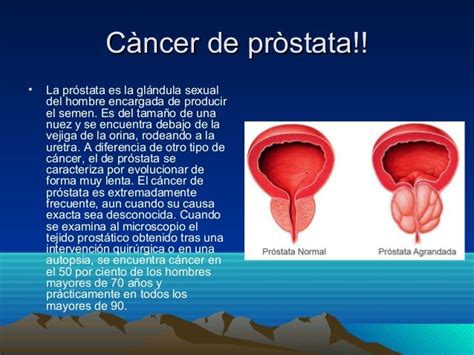 Cancer de prostata c 2
