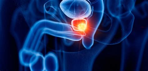 Cáncer de próstata: causas, síntomas y posibles tratamientos