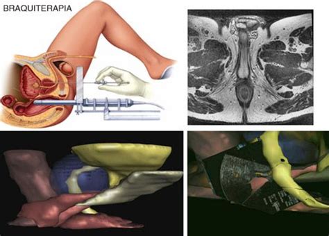 Cáncer de próstata | Centro Gil Vernet de Urología