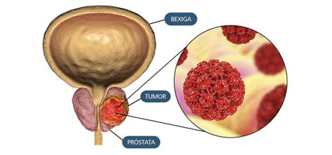 Câncer de Próstata   Clínica Med Imagem Guarapari