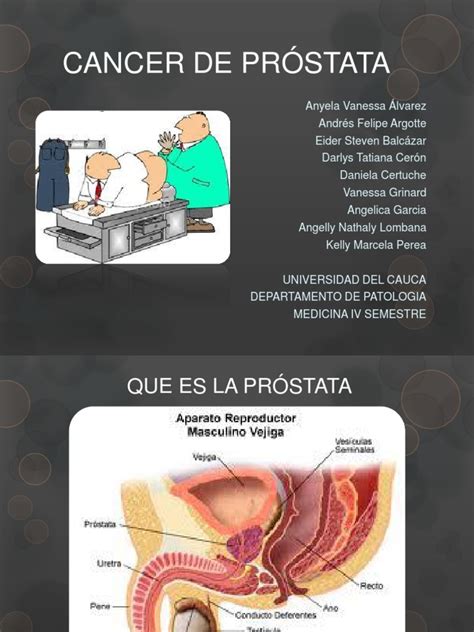 Cancer de Prostata Diapositivas
