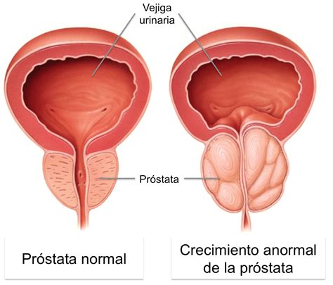 Cáncer de próstata en Torreón   Dr. Erik Leopoldo Serrano Ortega